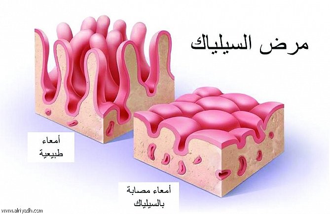 السيلياك.. العلاج الوحيد في تجنب كل غذاء فيه مادة الجلوتين
