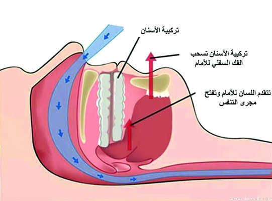 توقف التنفس أثناء النوم.. يزداد خلال مرحلة الأحلام